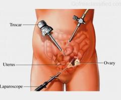 Treatment for Laparoscopic Hysterectomy in Ahmedabad
