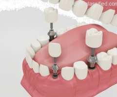 Dental implants in Ahmedabad | Aashu dental | 9825158578